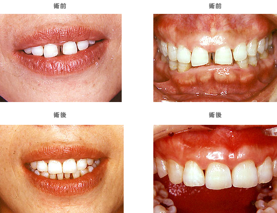 審美補綴：　歯と歯の間に隙間が空いている
