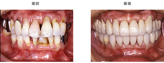 歯周補綴：　歯がグラつく