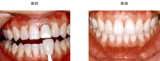 セラミッククラウン：　歯をキレイにしたい