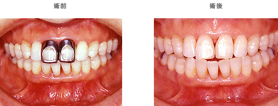 セラミッククラウン：　以前の治療をやり治したい