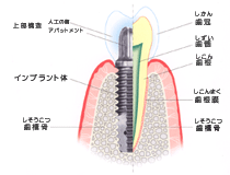 インプラント治療