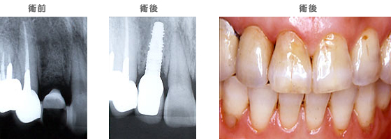 インプラントの治療ケース1