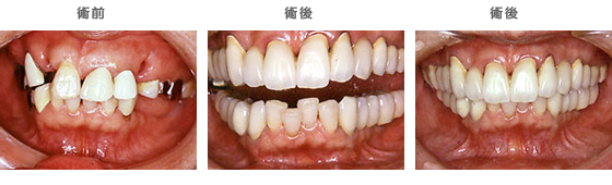 インプラントの治療ケース2