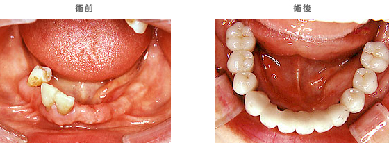 インプラントの治療ケース3