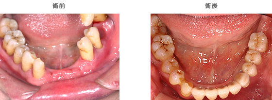 インプラントの治療ケース4