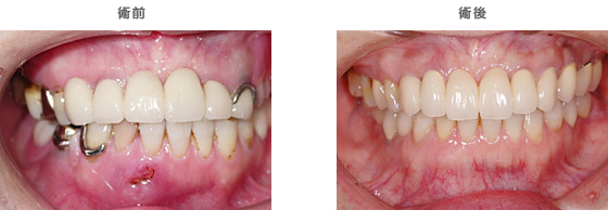 インプラントの治療ケース6