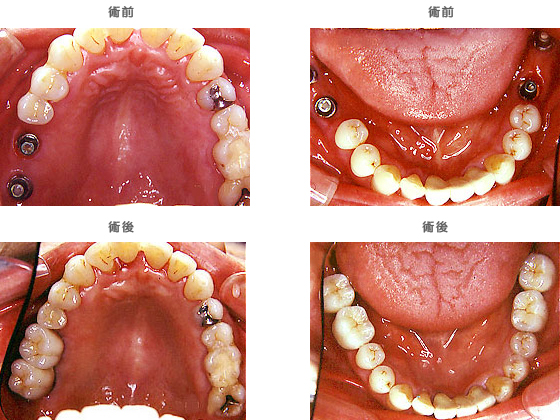インプラントの治療ケース8