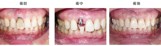 インプラントの治療ケース9