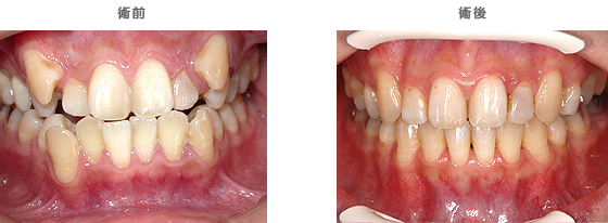 歯並びが悪い