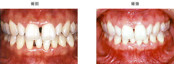 歯周病治療：　歯と歯の間に隙間が空いている