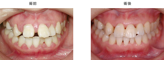 歯周病治療：　歯ぐきから膿が出る