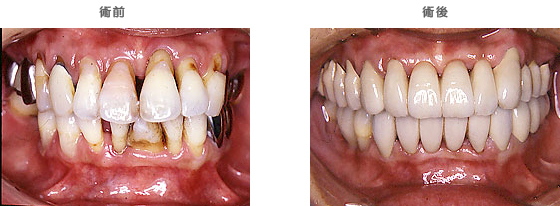 歯周補綴治療：　歯がグラつく