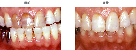 ホワイトニング：　歯の色が変色している