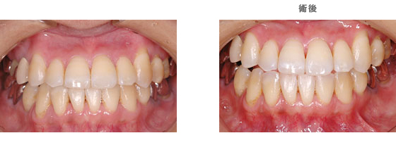 ホワイトニング：　歯をキレイにしたい